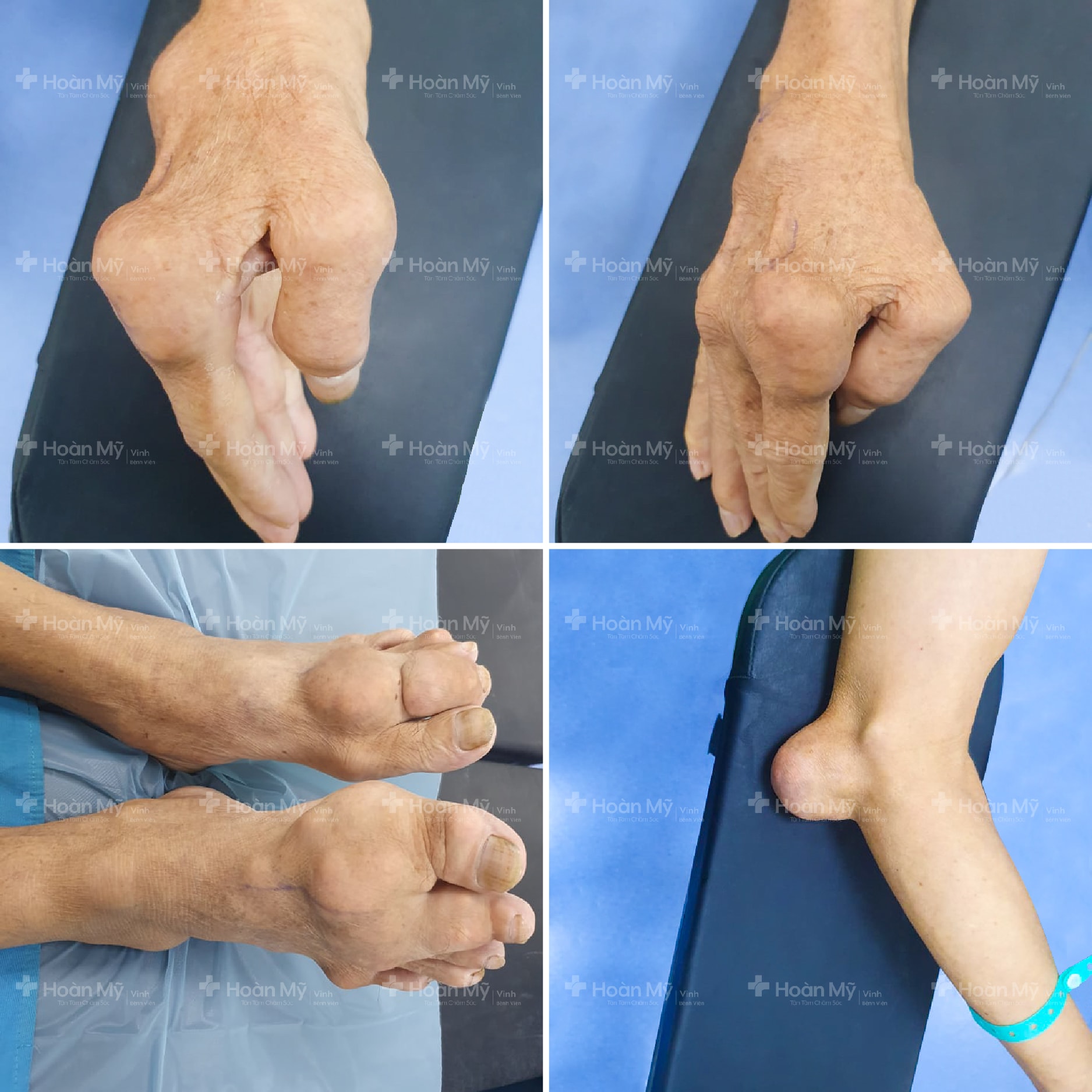 Hình ảnh tứ chi người bệnh biến dạng vì bệnh gout. Ảnh: Kim Chung