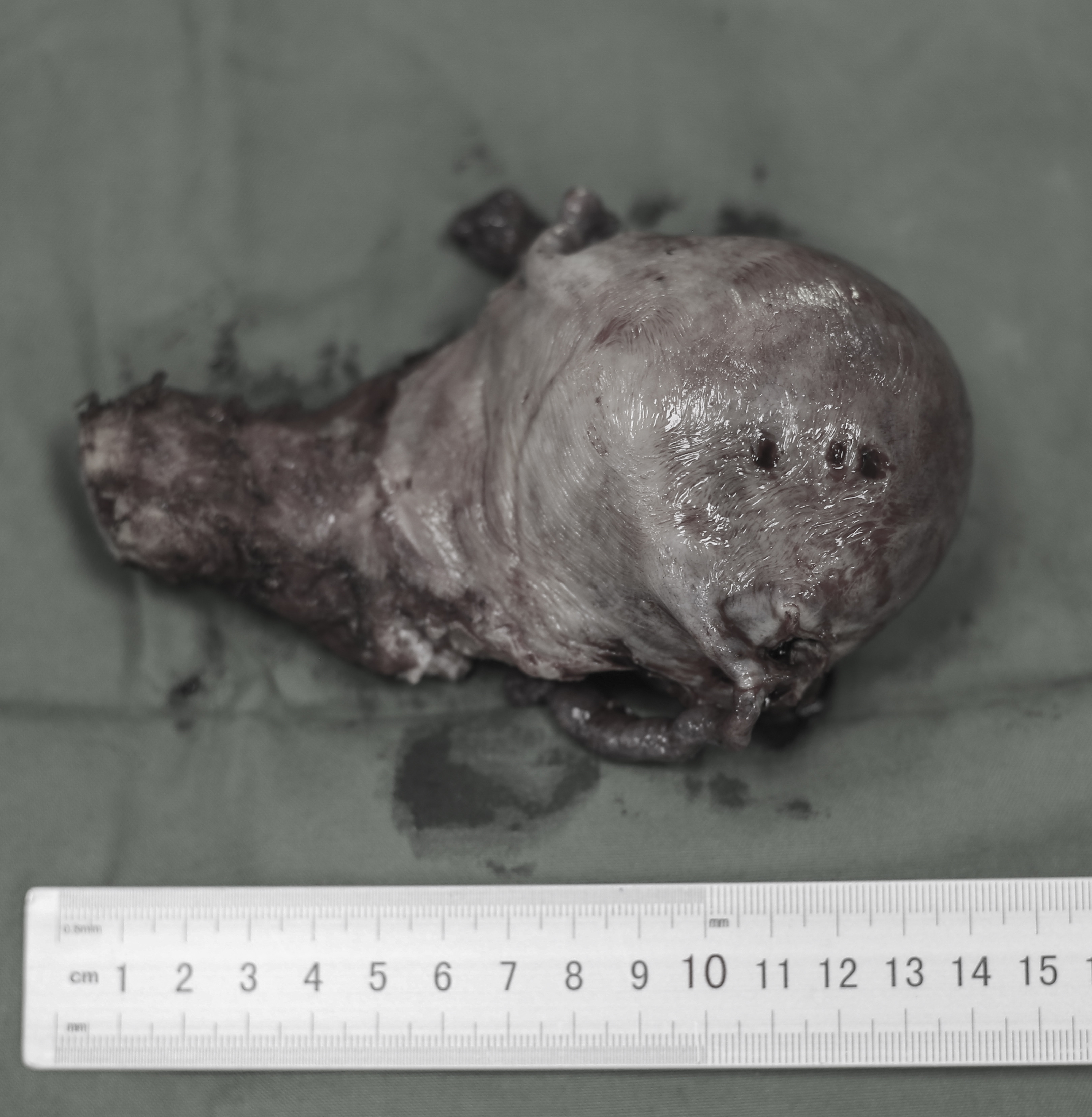 Hình ảnh khối u xơ được bóc tách khỏi cơ thể bệnh nhân sau phẫu thuật. ảnh Kim Chung.