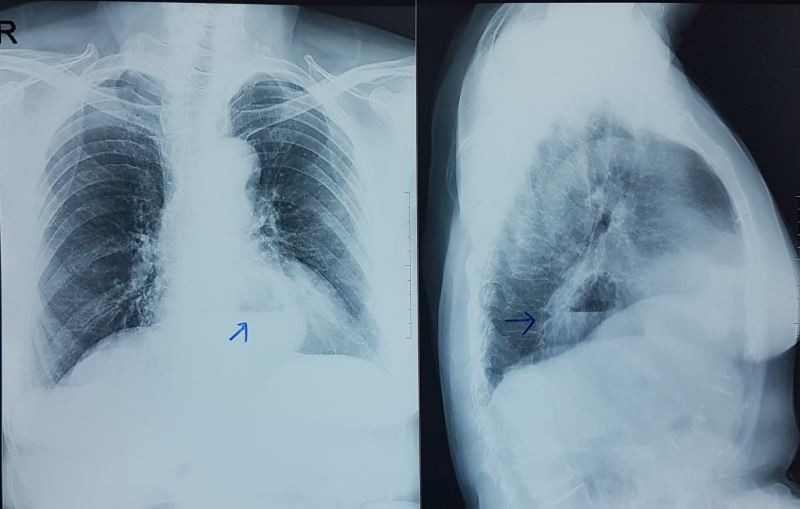 Kết quả chụp Xquang giúp tình cờ phát hiện bệnh nhân mắc thoát vị hoành Kết quả chụp CT canner của bệnh nhân