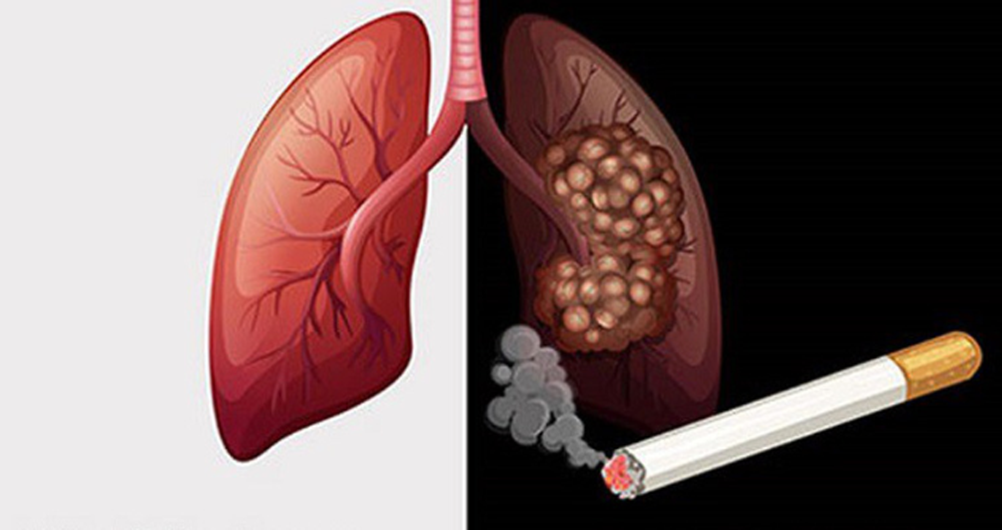 Hút thuốc lá là tác nhân gây nên nhiều bệnh ở phổi. Ảnh: Nguồn Internet