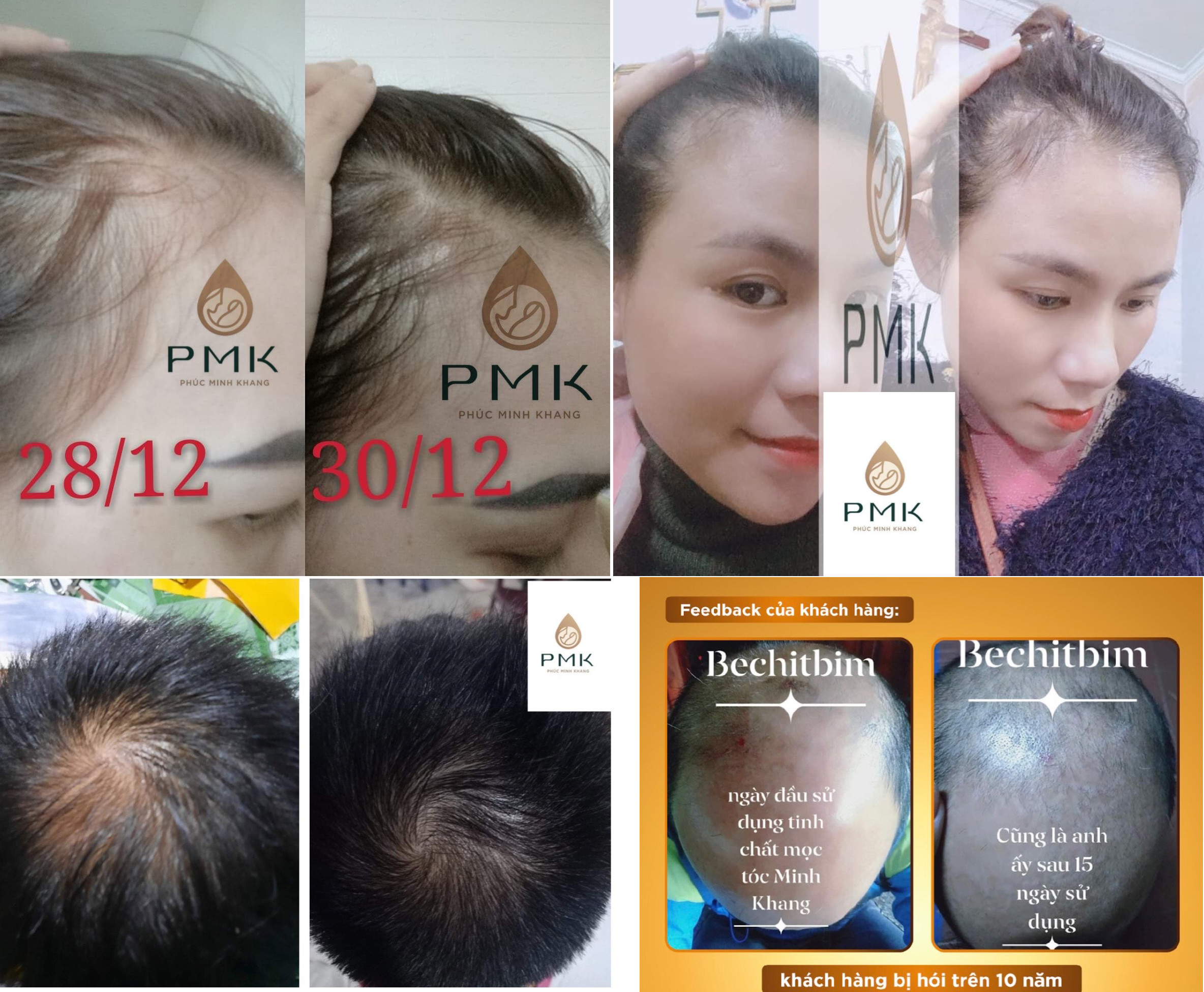 Tinh chất mọc tóc cao cấp Minh Khang được đông đảo khách hàng tin dùng, bởi hiệu quả cao trong chữa rụng, hói tóc lâu năm.
