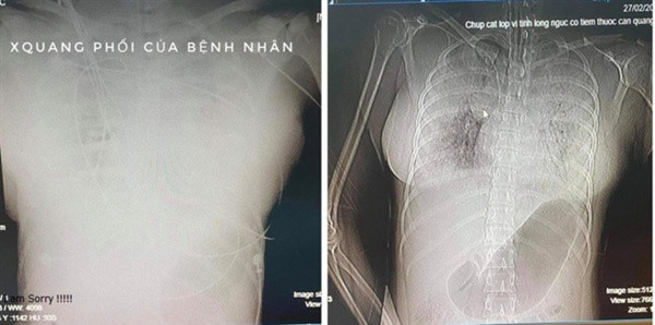 Hình ảnh chụp X-quang và CT cho thấy phổi đông đặc, xuất huyết nhiều