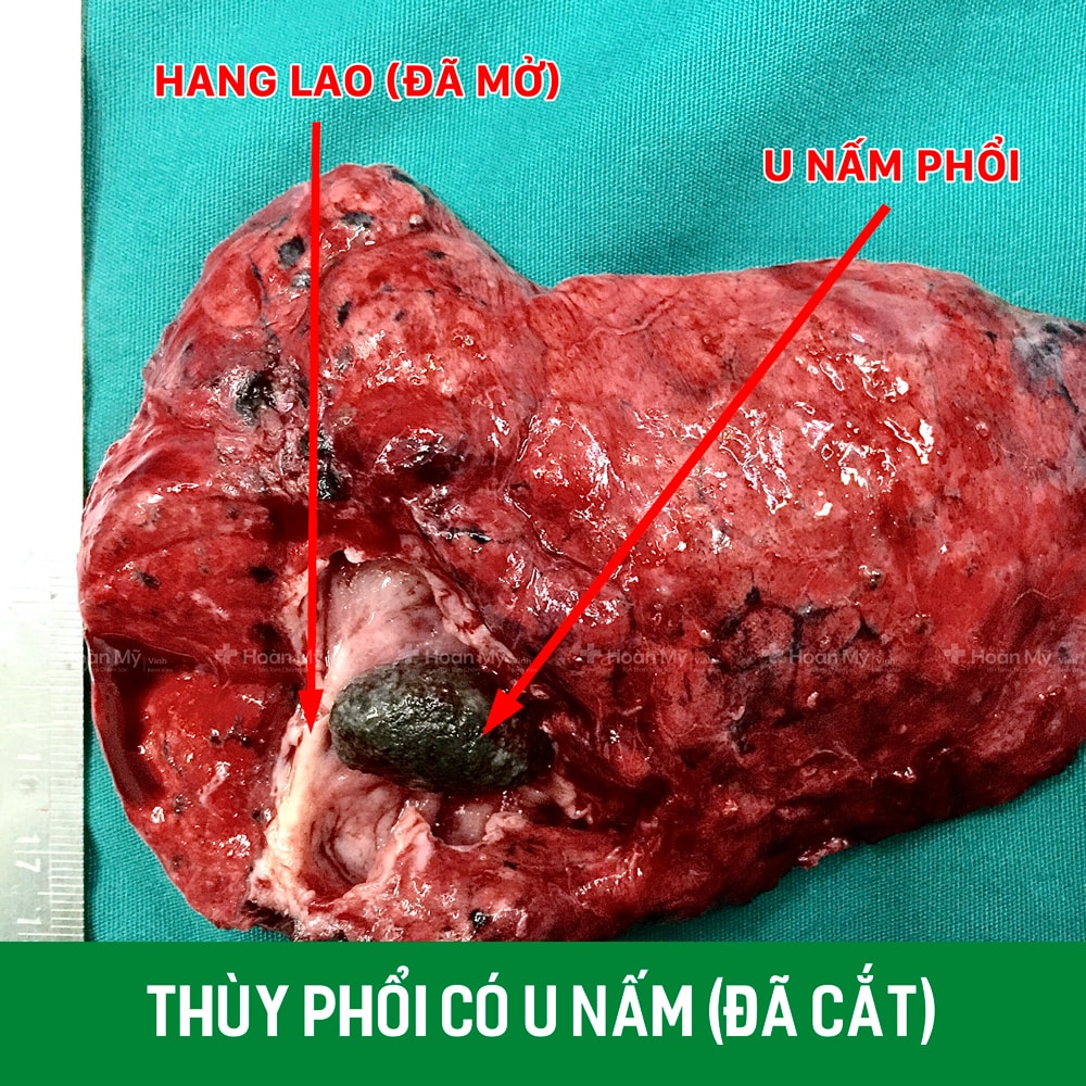Thùy phổi có u nấm (đã cắt) của bệnh nhân.