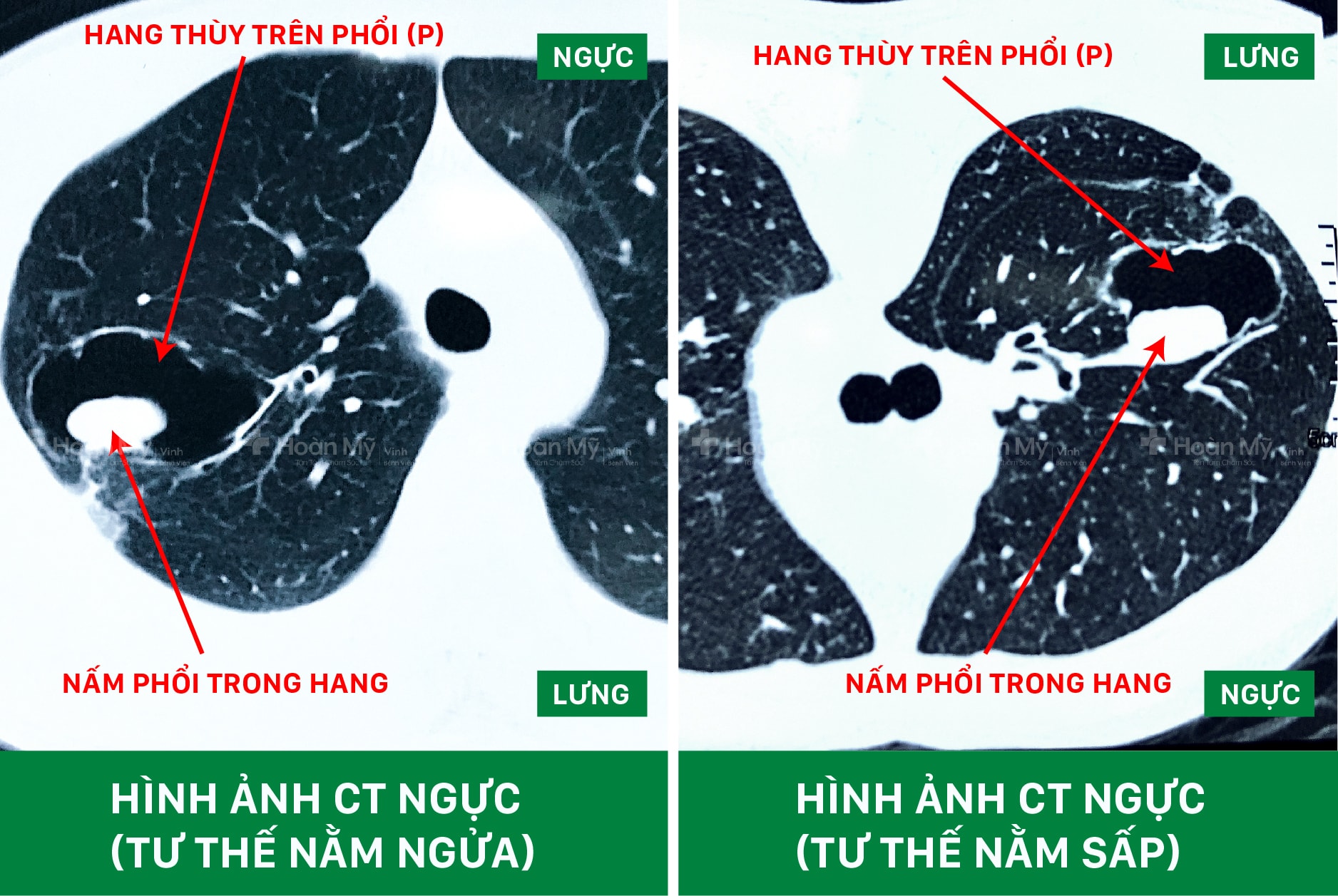 Hình ảnh CT ngực của bệnh nhân. 