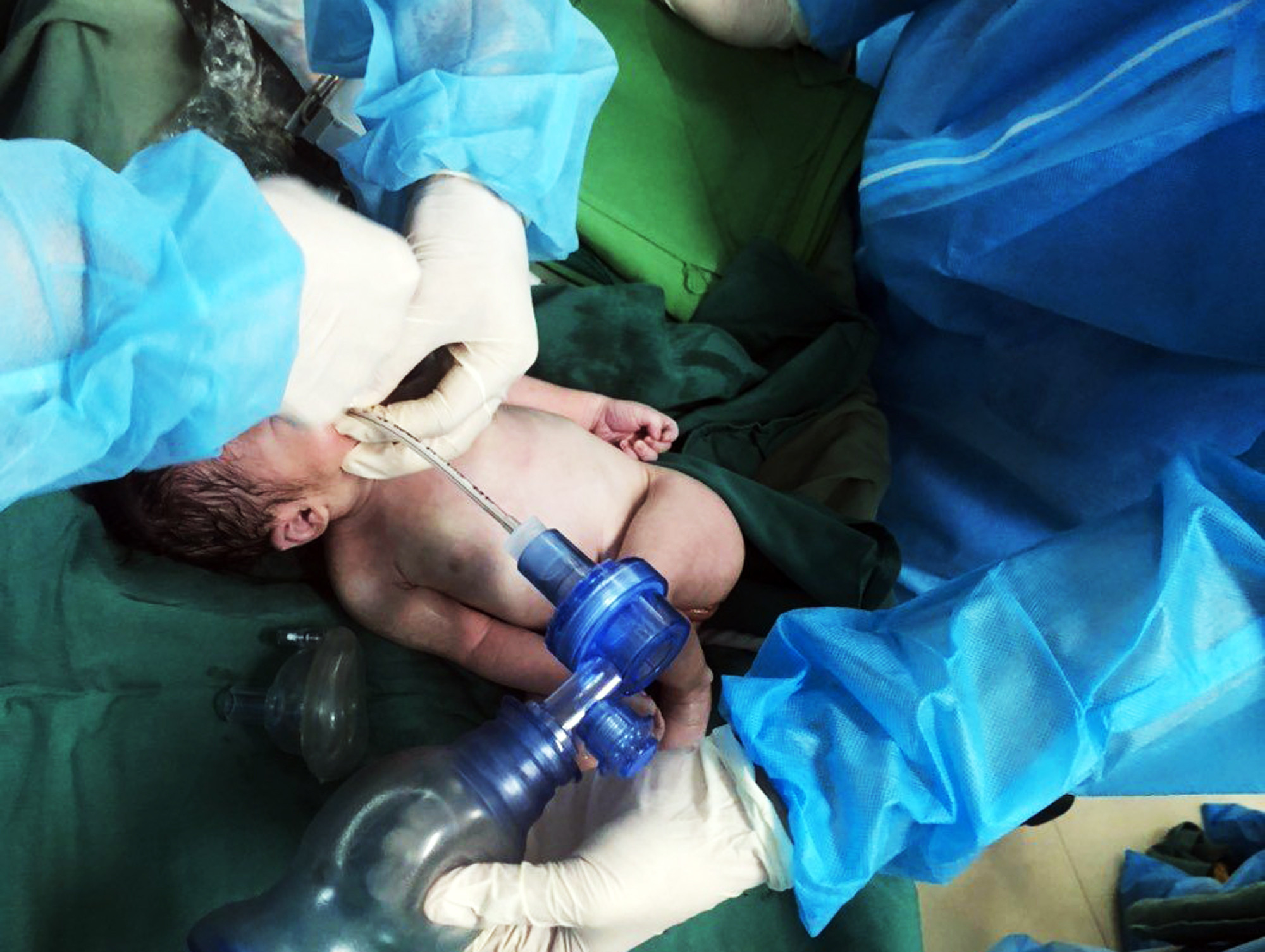 Êkip bác sỹ hồi sức sơ sinh đang cấp cứu bé ngay khi vừa chào đời. Ảnh: Hoàng Yến