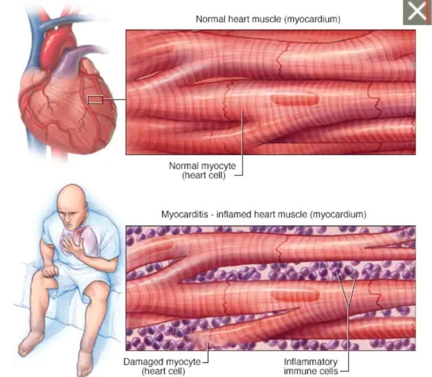 Hình ảnh minh họa viêm cơ tim