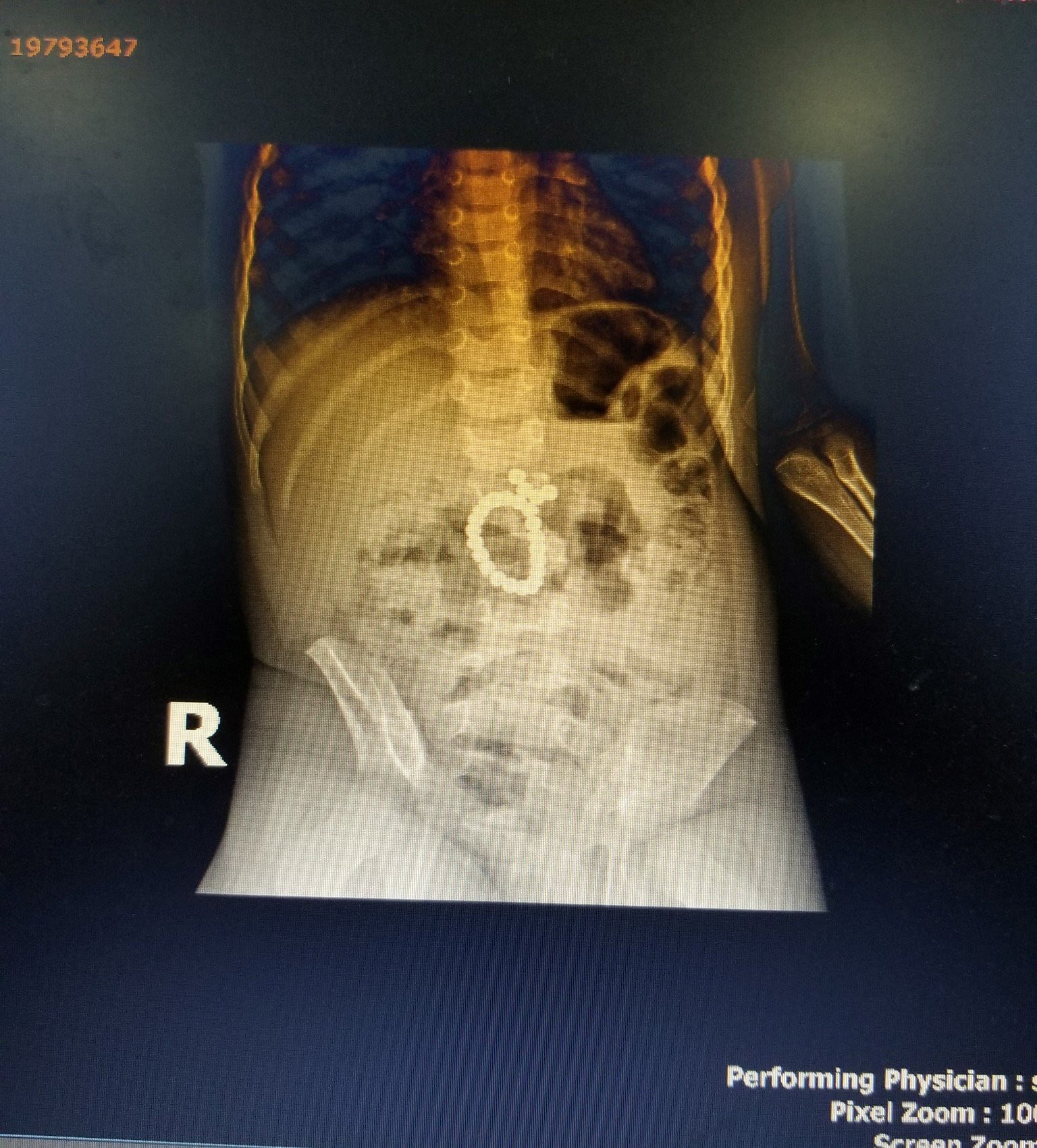 Kết quả chụp X-Quang ổ bụng bệnh nhân. Ảnh: Yến Phương