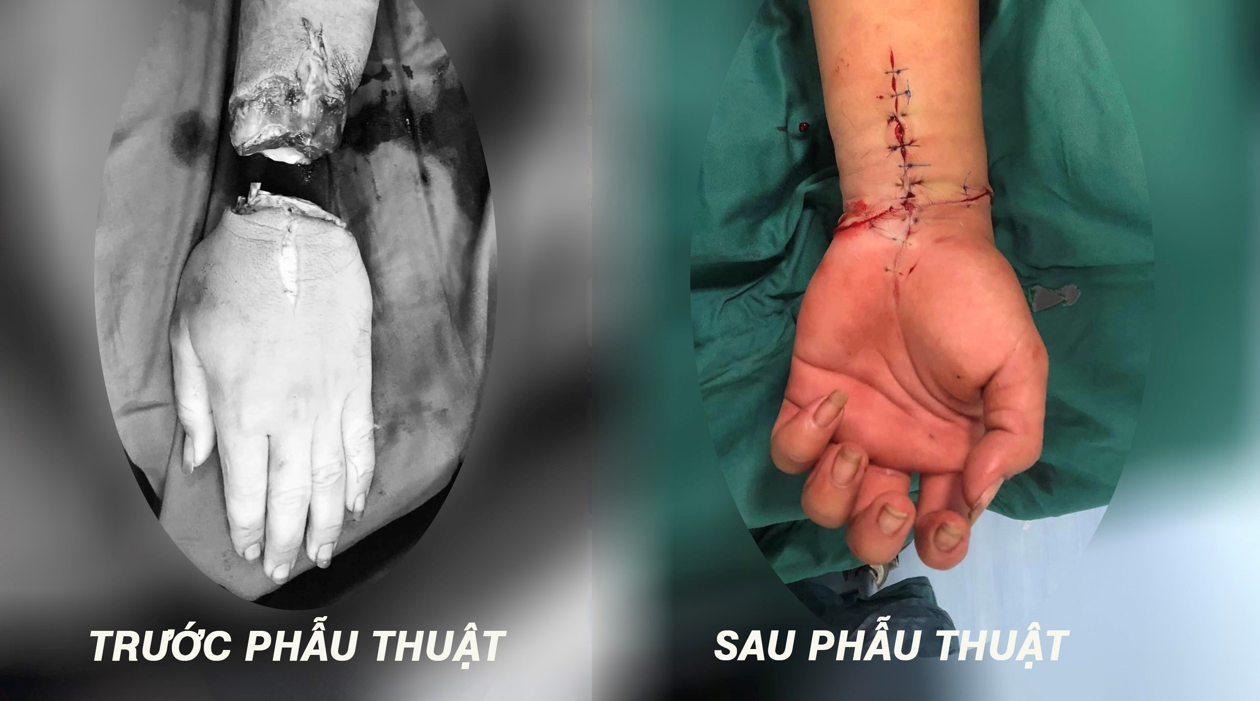 Hình ảnh bàn tay đứt lìa của bệnh nhân N. trước và sau phẫu thuật