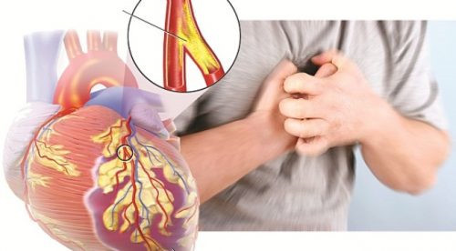 Ảnh bài 1- Hút thuốc lá làm tăng nguy cơ mắc bệnh tim mạch, đột quỵ (1).jpg