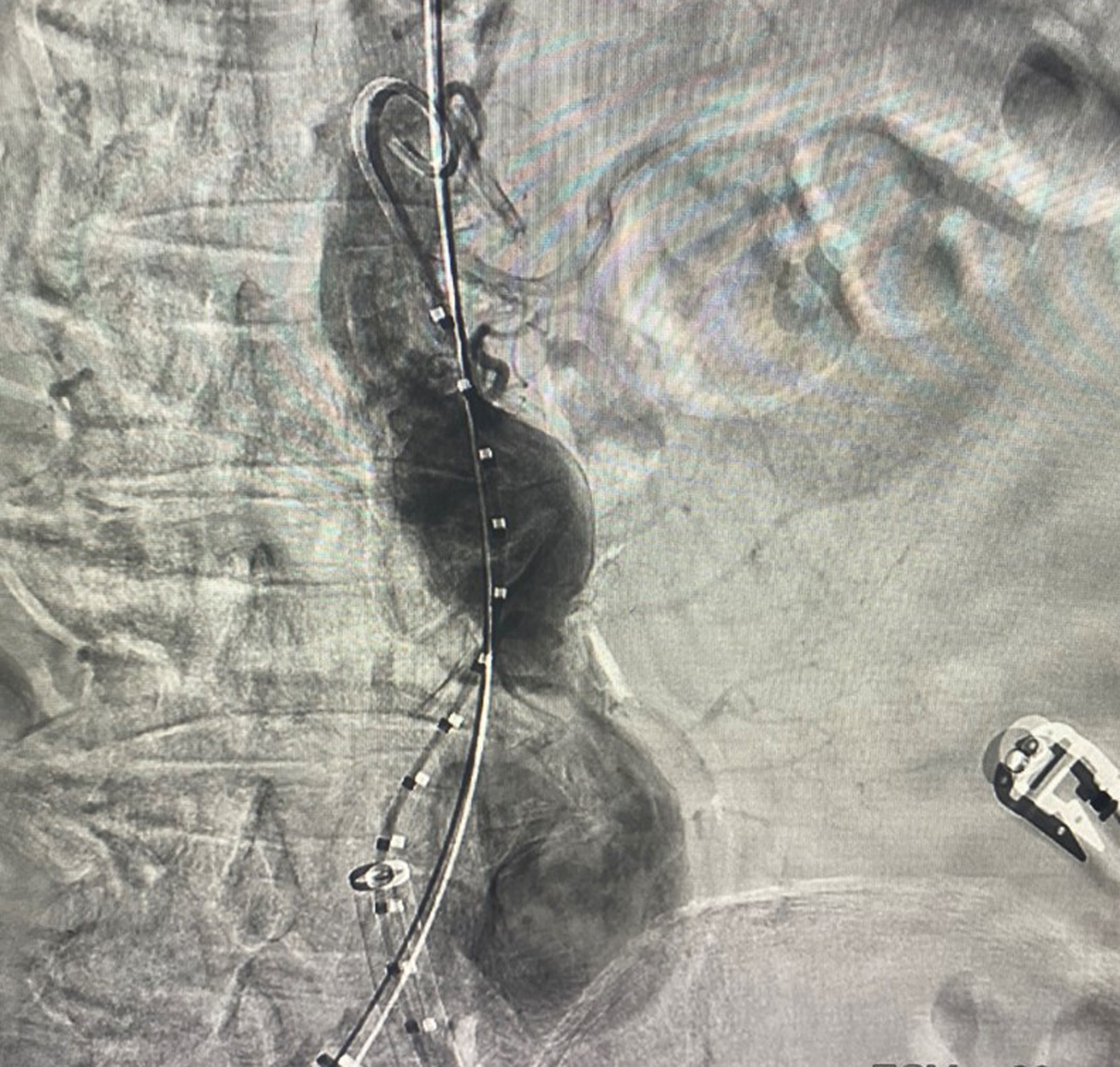 bna_Hình ảnh phình động mạch chủ bụng của bệnh nhân N.H.K. trước và sau khi phẫu thuật đặt Stent Graft.jpg