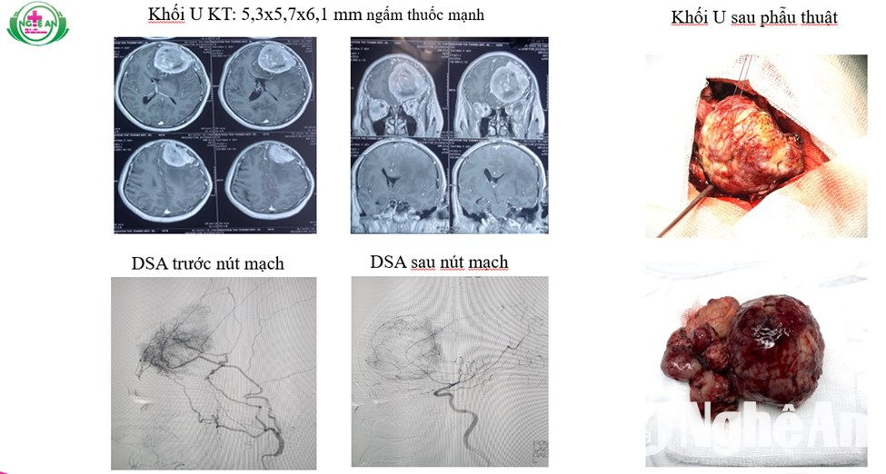 Hình ảnh khối u trước và sau mổ của bệnh nhân N.T.Th, 60 tuổi