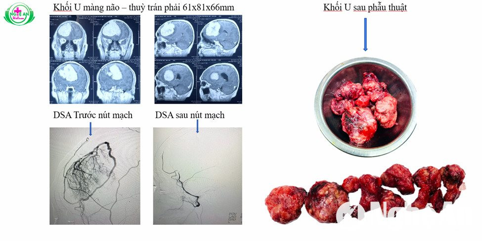 Hình ảnh khối u trước và sau mổ của bệnh nhân T.T.Ng, 76 tuổi