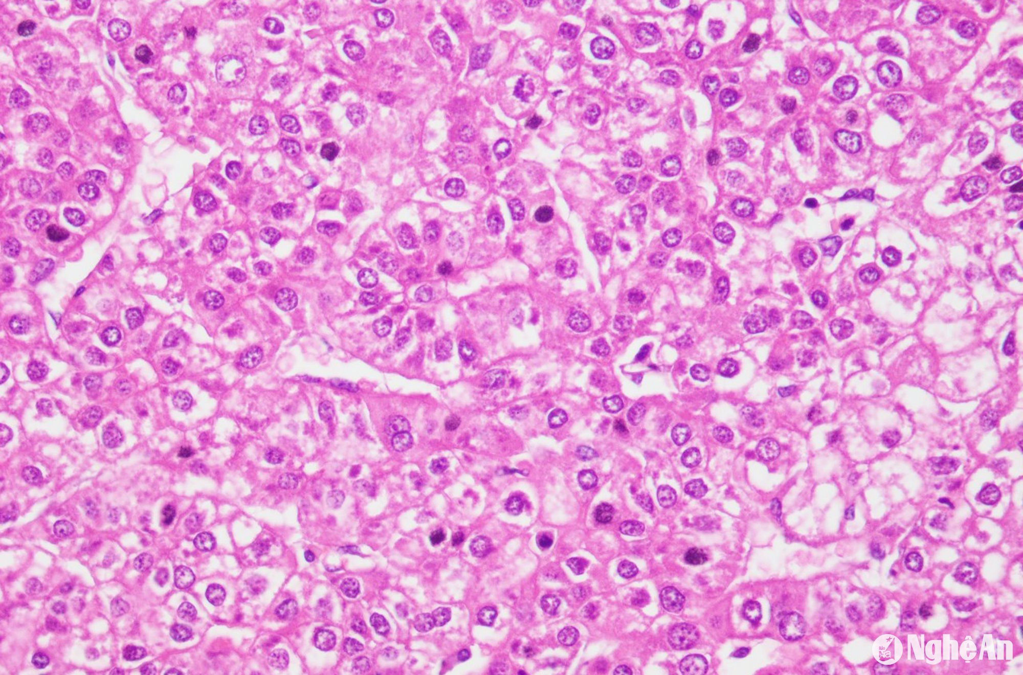 Hình ảnh vi phẫu ung thư tế bào gan của bệnh nhân.Ảnh BVHNĐKNA