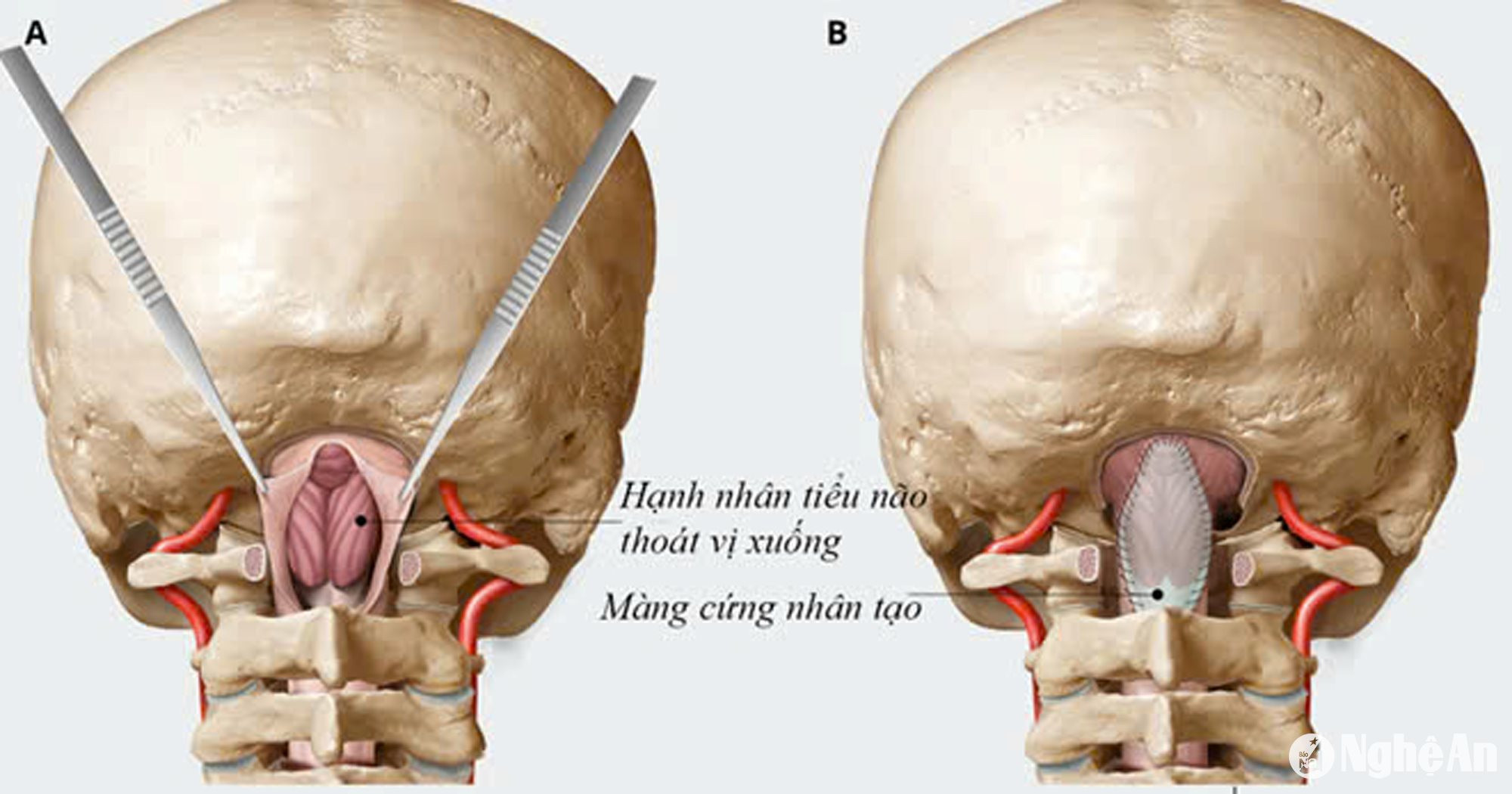 Ảnh BVHNĐK NA