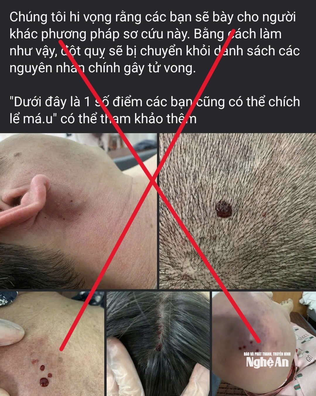 Đột quỵ...