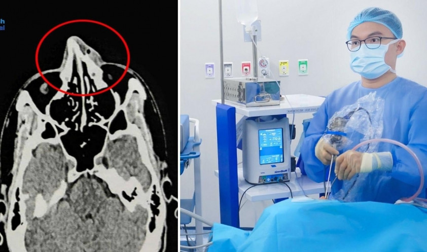 Bác sĩ khuyến cáo người chơi thăm khám sớm khi mũi sưng, đau, chảy máu