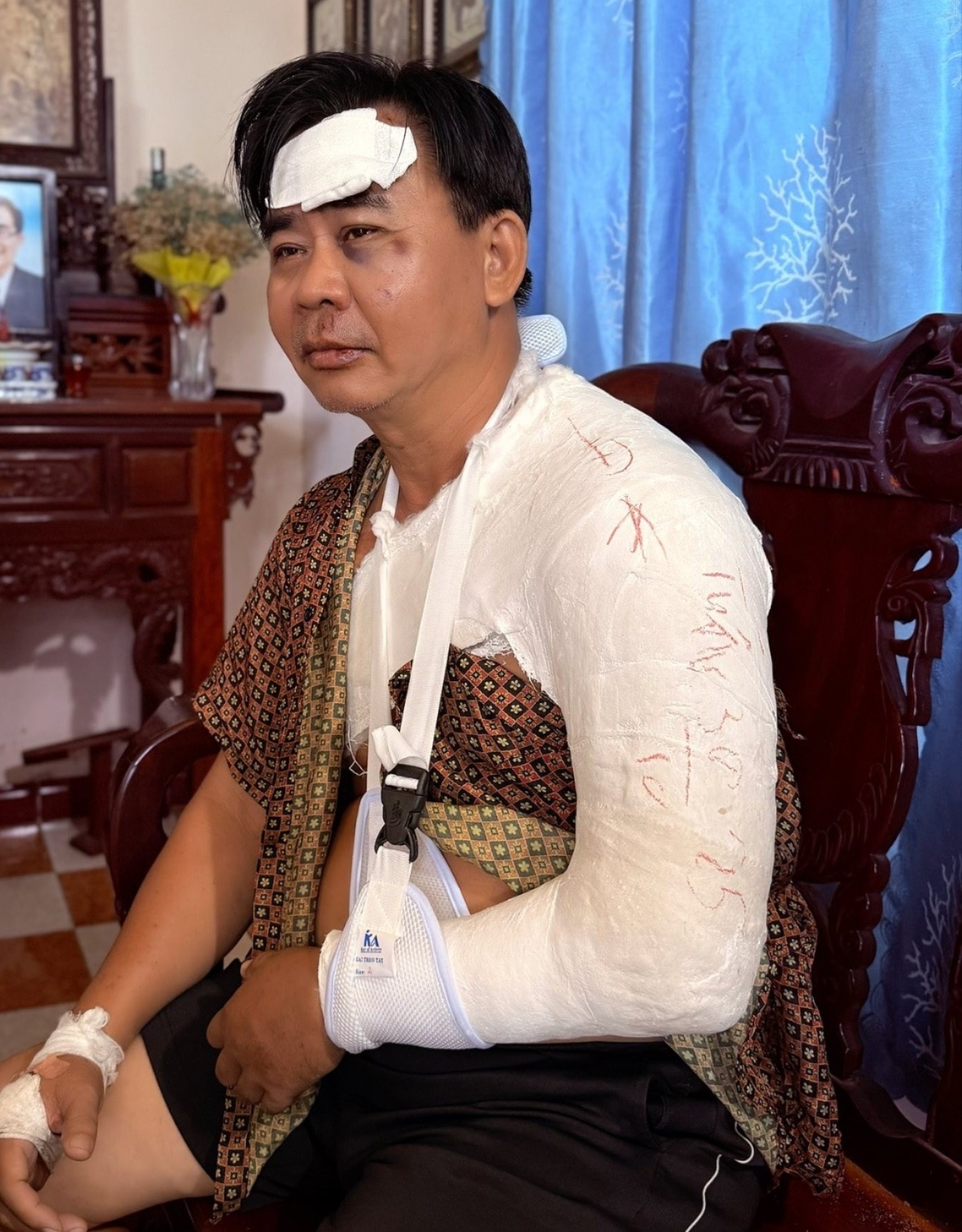 Nghệ sĩ Chánh Thuận phải bó bột ở vai sau tai nạn.