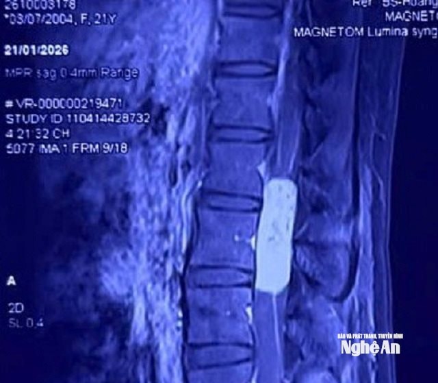 HA u trên phim chụp MRI