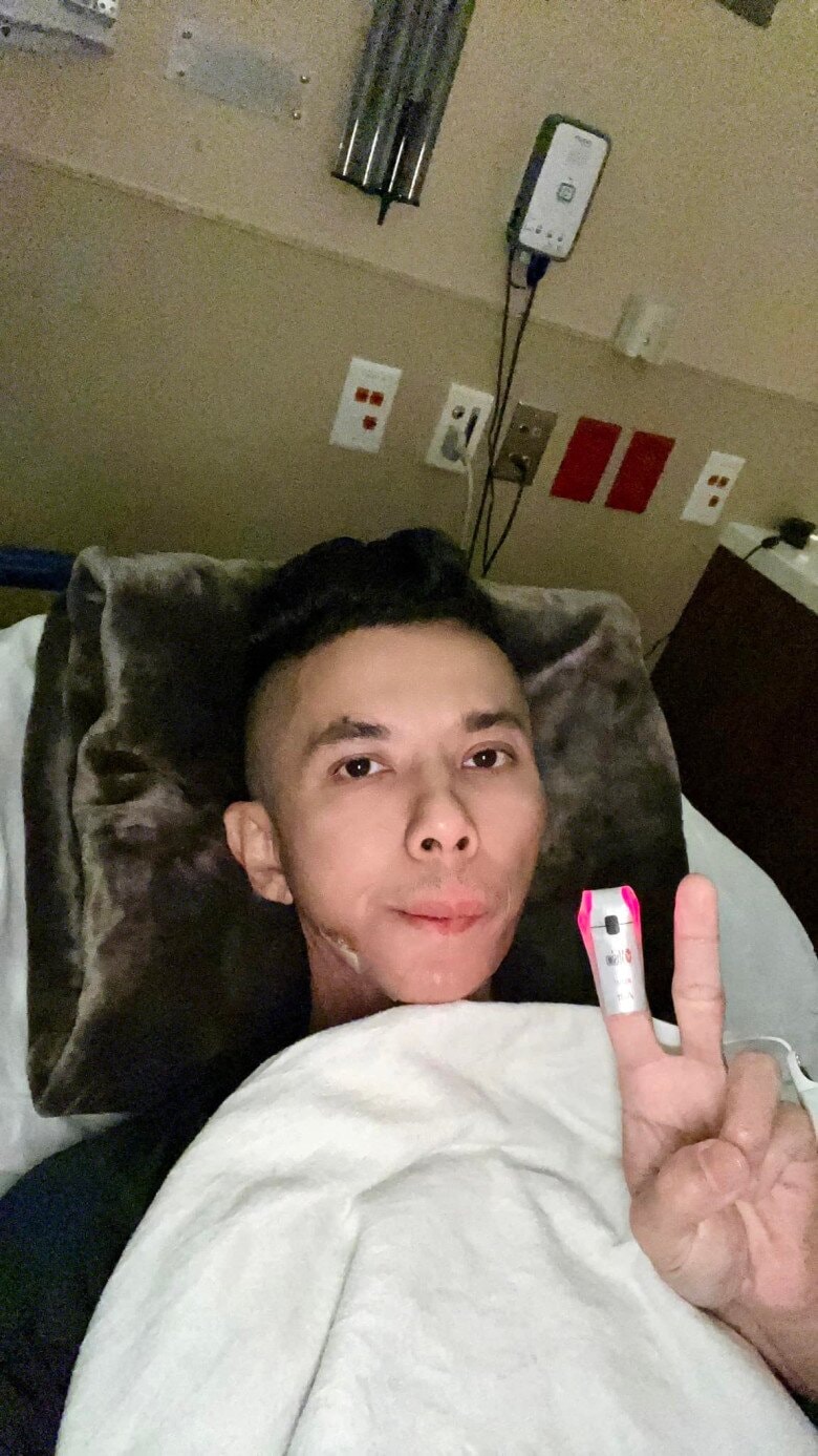 Ngoại hình gầy gò của Kasim Hoàng Vũ do biến chứng bệnh viêm khớp xương hàm.
