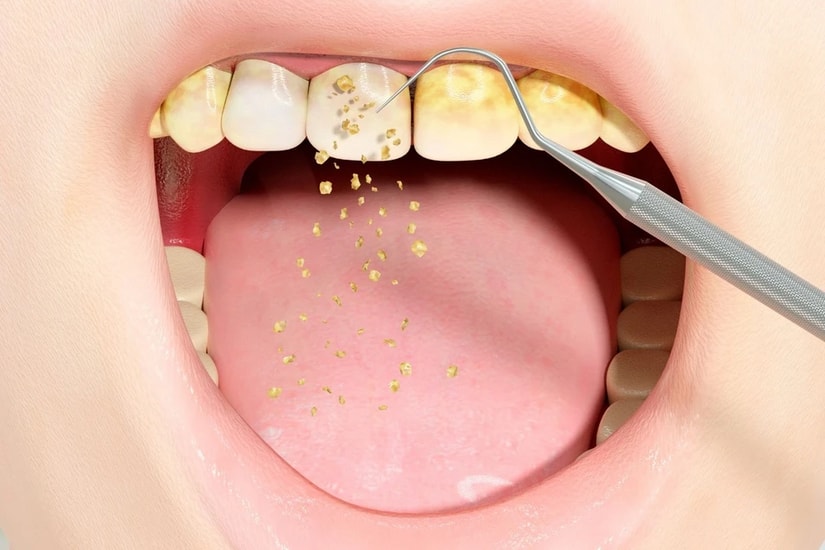 Lấy cao răng định kỳ để bảo vệ sức khỏe răng miệng