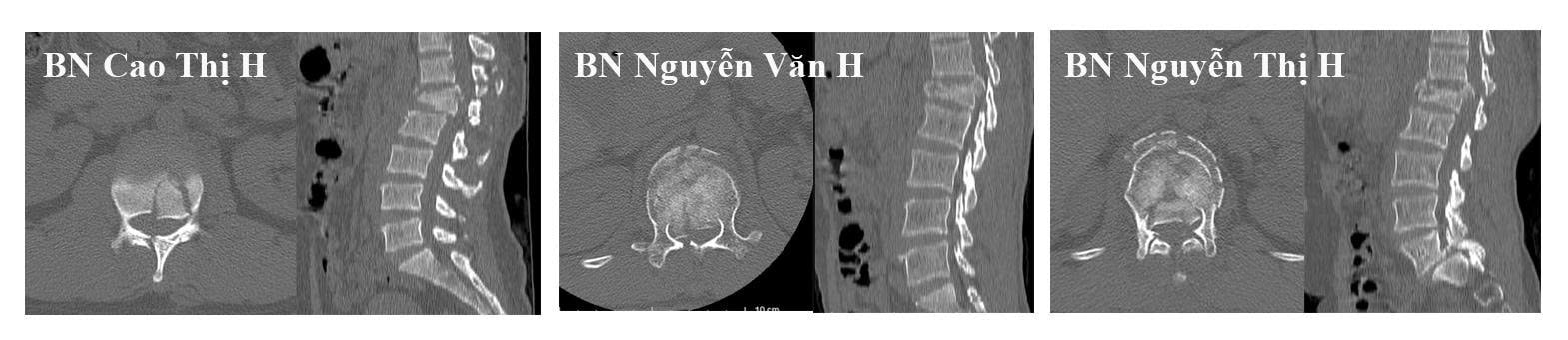 Phim CLVT cột sống của các bệnh nhân