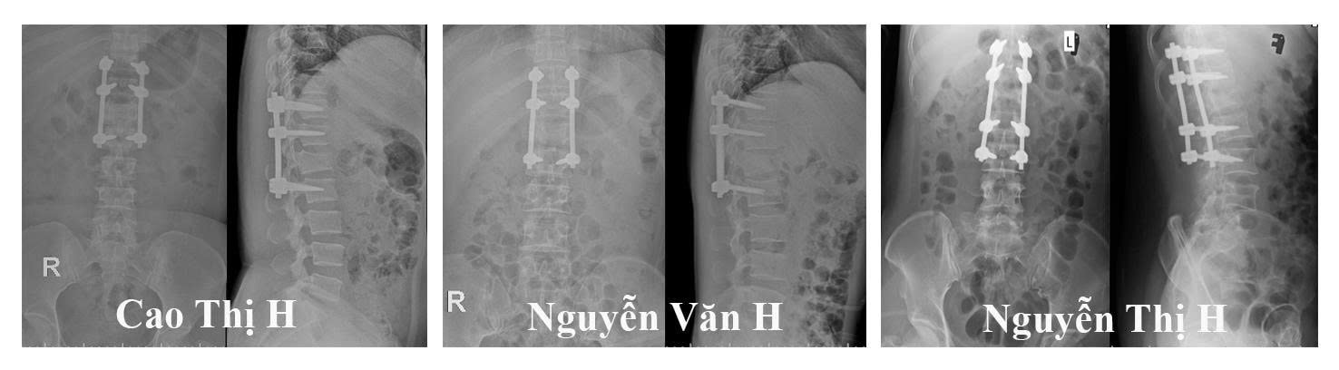 Phim XQ sau mổ của các bệnh nhân