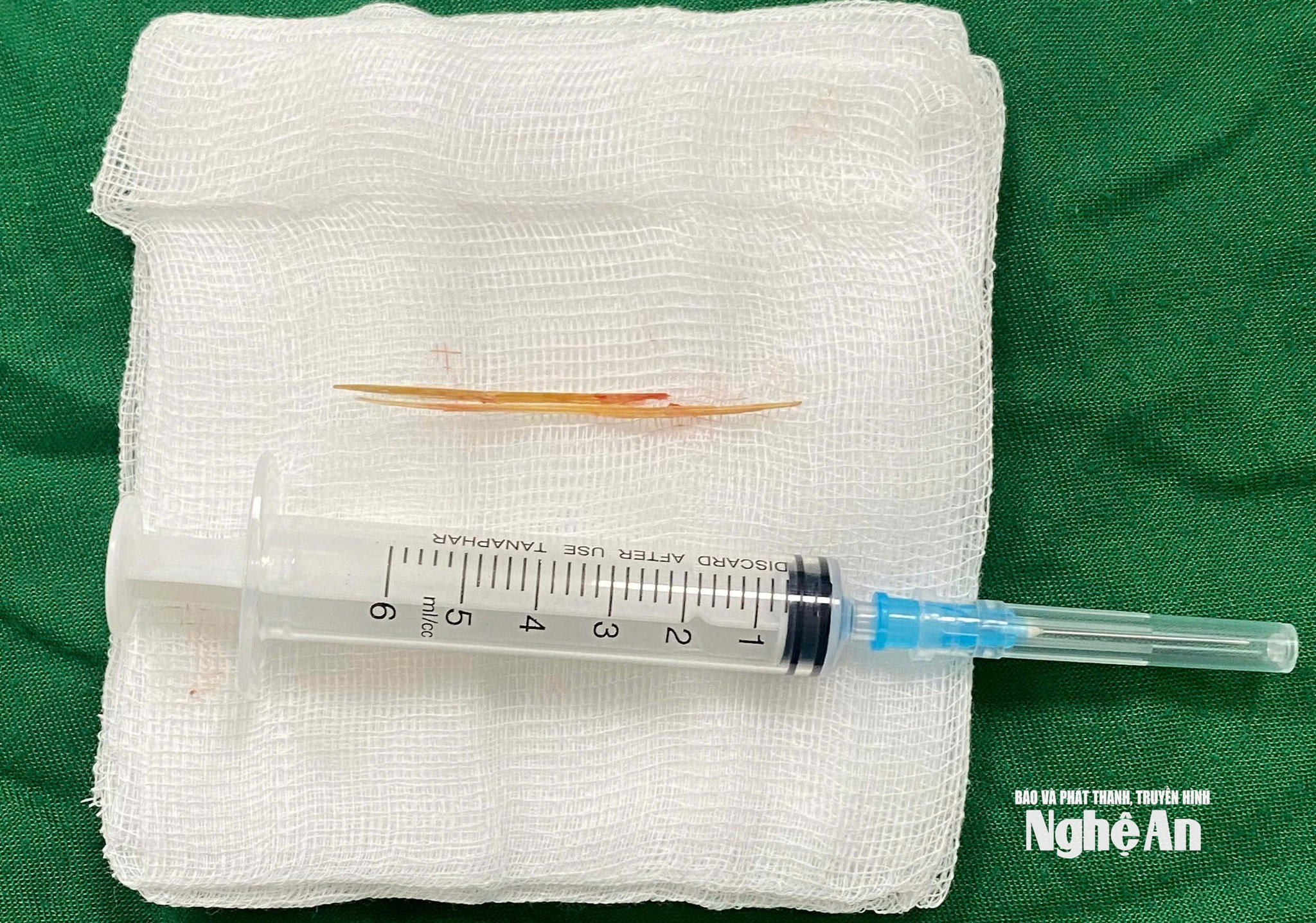 Hình ảnh dị vật tăm tre được loại bỏ (1)