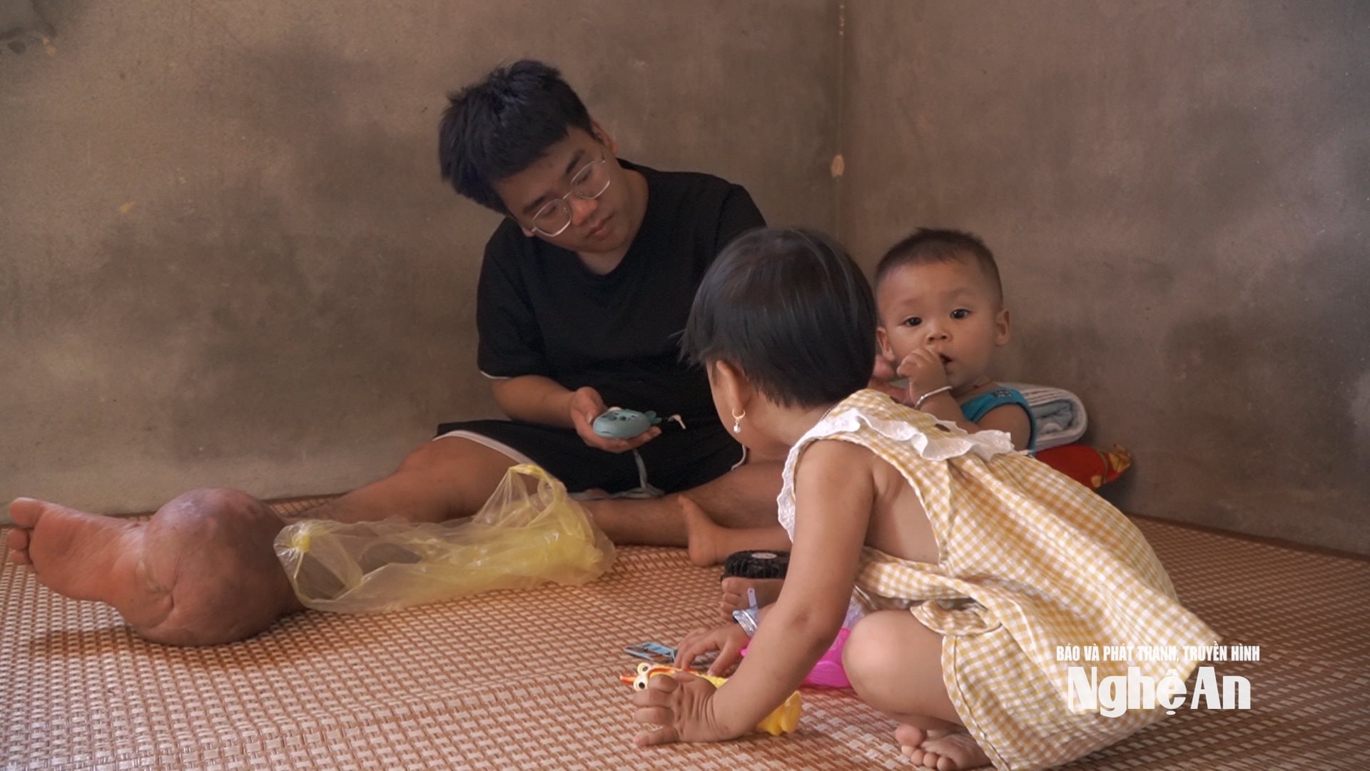 Lang Văn Yên với khối u dị tật lớn ở chân