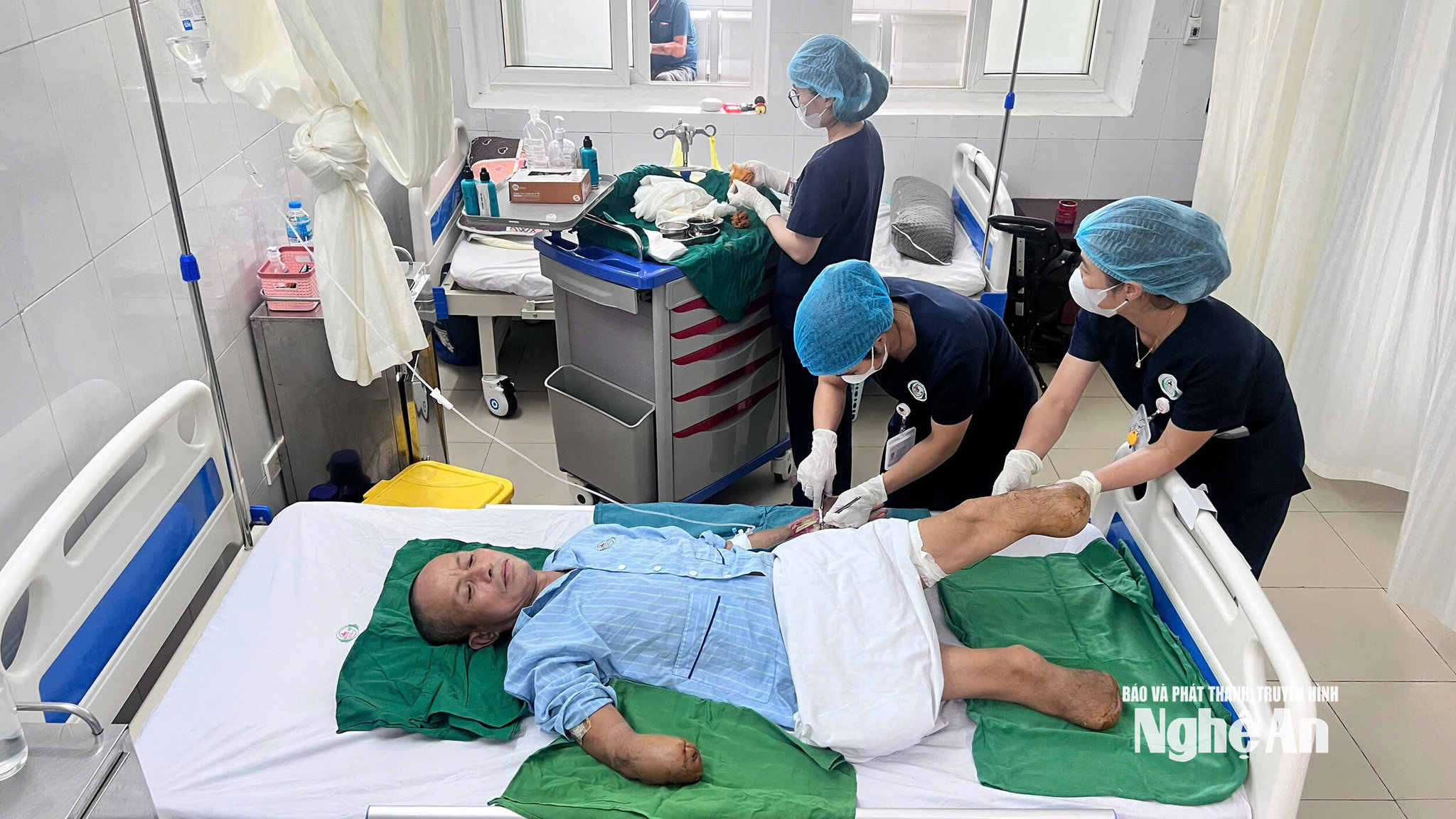 Anh Hoàng Văn Thạch sau tai nạn điện giật. Ảnh: Ngọc Dũng