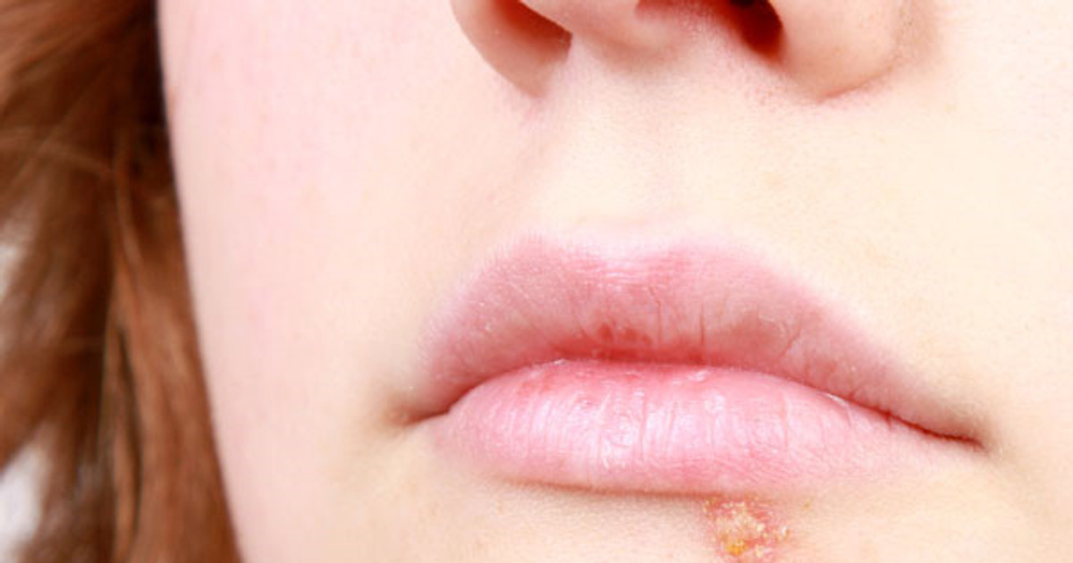 vitamin c deficiency on lips Angular Cheilitis: What Is It, Causes, Treatment, and More