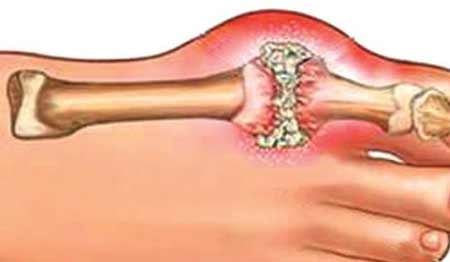Những hiểu nhầm về bệnh Gout