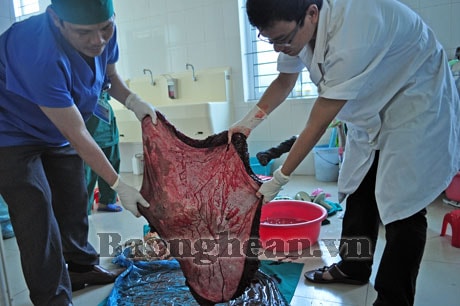 Phẫu thuật thành công bệnh nhân mang khối u khổng lồ