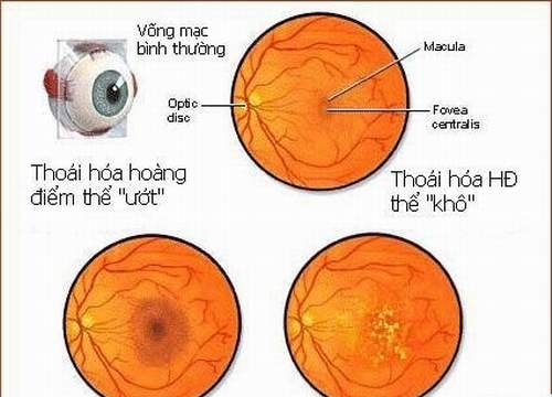 Thoái hóa hoàng điểm tuổi già