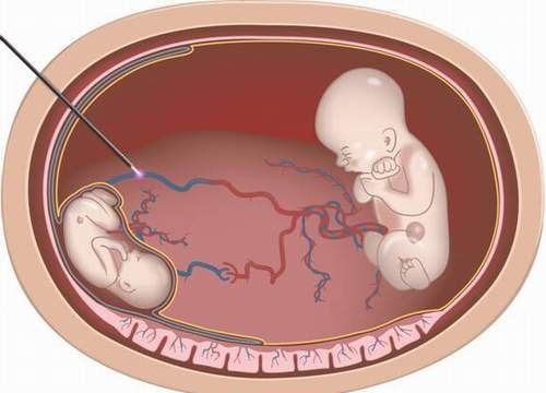Những nguy cơ tiềm ẩn khi song thai