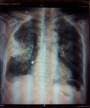 Gắp thành công kẹp sắt, bã trầu, bánh răng bật lửa… trong bụng bệnh nhân bằng mổ nội soi