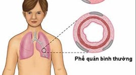 Dự phòng cơn hen phế quản bùng phát khi chuyển mùa