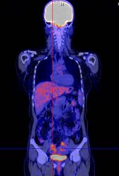 Phương pháp mới trong chẩn đoán ung thư buồng trứng