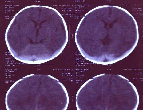 Trẻ thiếu vitamin K rất dễ xuất huyết não