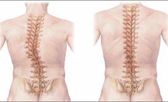 Phát hiện sớm chứng vẹo cột sống ở trẻ em