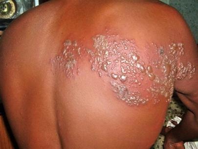 Những thuốc không được sử dụng trong bệnh "giời leo"