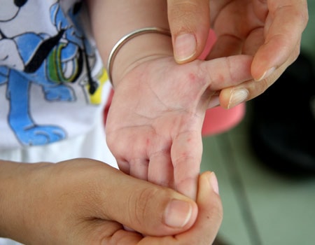 Đã tìm ra vắc xin phòng bệnh tay, chân, miệng