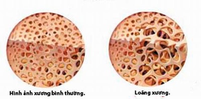 Phòng ngừa loãng xương sau mãn kinh