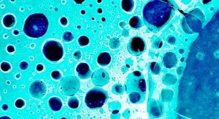 "Huấn luyện" tế bào tiêu diệt bệnh bạch cầu