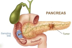 Phương pháp mới chẩn đoán sớm bệnh ung thư tụy
