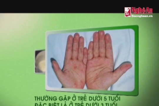 Thông điệp phòng chống bệnh Tay – Chân – Miệng