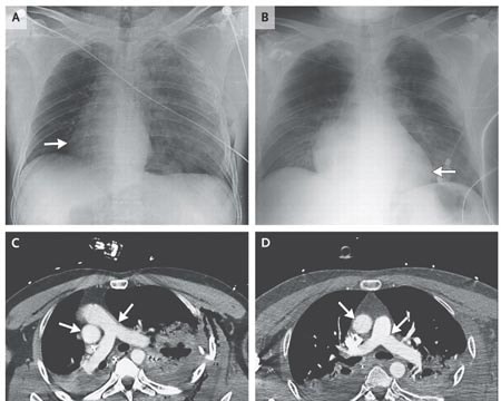 Người đàn ông có trái tim "dạo chơi" trong lồng ngực