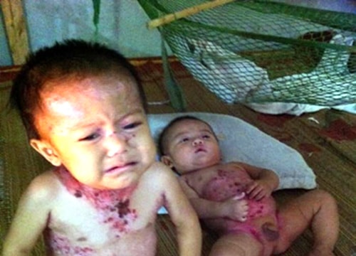 10,5 triệu đồng ủng hộ hai cháu bé bị bệnh ở Thạch Sơn