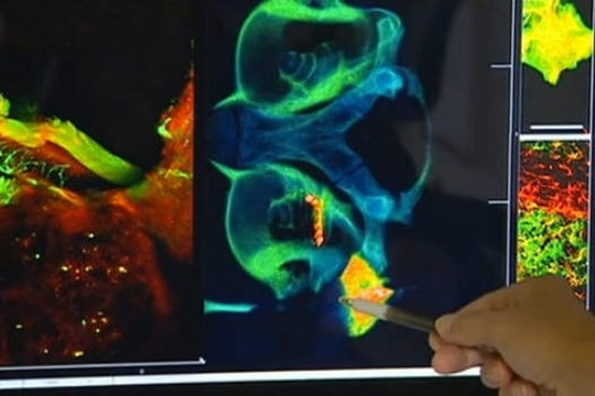 Phát triển công nghệ chụp não cho bệnh nhân cấy ghép ốc tai