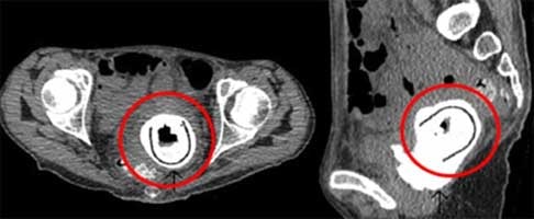 "Bỏ quên" đồ chơi tình dục suốt 10 năm trong cơ thể