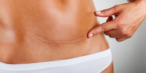 7 triệu chứng của bệnh ung thư buồng trứng